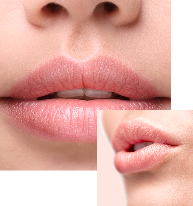 Aumento de labios Ácido Hialurónico