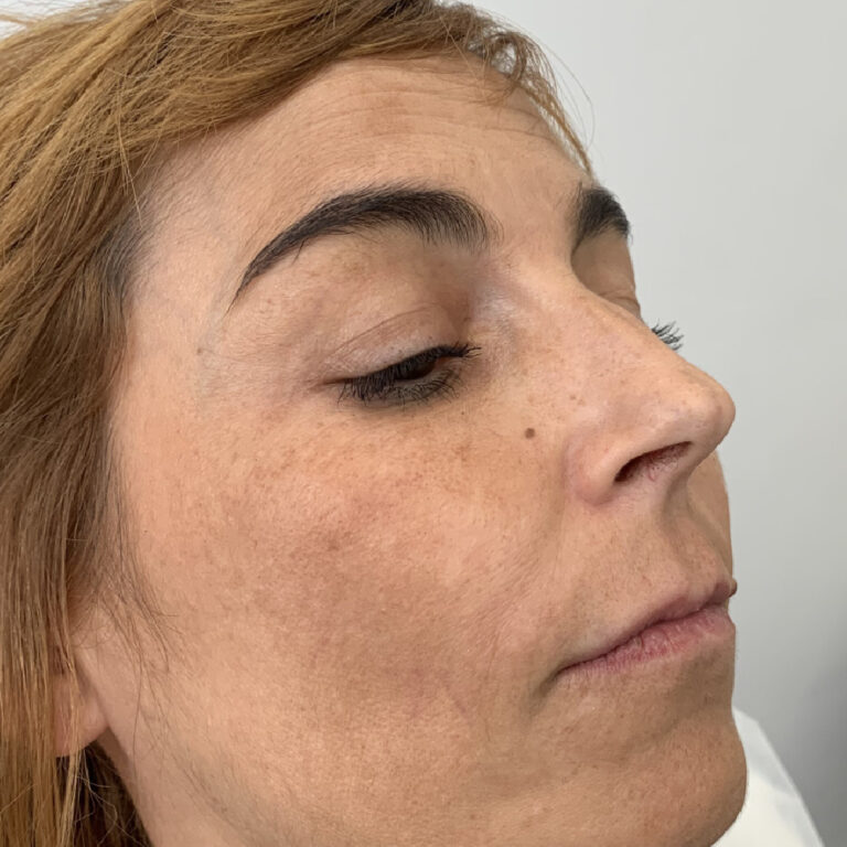 Tratamiento láser facial