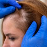beneficios de la mesoterapia capilar