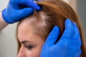 beneficios de la mesoterapia capilar
