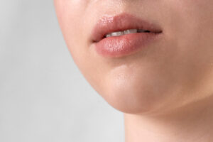 ¿Cuánto dura el ácido hialurónico en los labios?