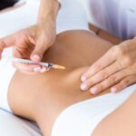 Carboxiterapia: antes y después